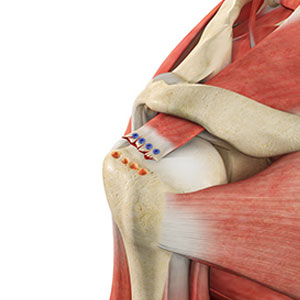 Rotator Cuff Tear - Educational Photo