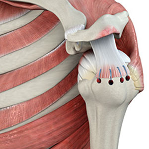 Rotator Cuff Repair - Educational Photo