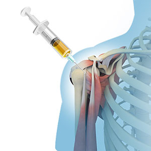Orthobiologics Treatment for Shoulder - Educational Photo