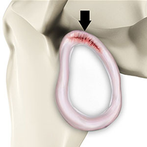 SLAP Tears - Educational Photo