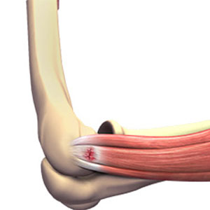 Tennis Injuries - Educational Photo