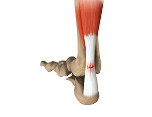 Achilles Tendon Rupture - Educational Photo