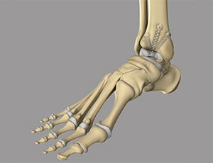 Ankle Arthrodesis - Educational Photo