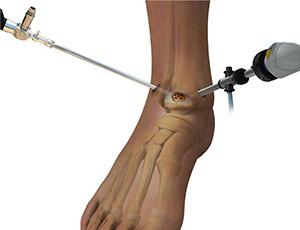 Arthroscopic Ankle Joint Cartilage Repair - Educational Photo