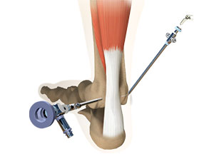 Ankle Arthroscopy - Educational Photo
