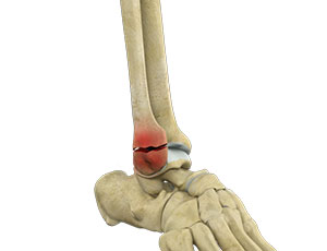 Ankle Fractures - Educational Photo