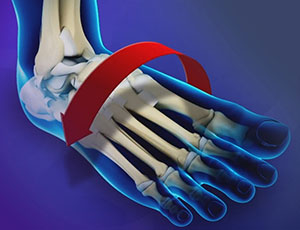Ankle Instability - Educational Photo