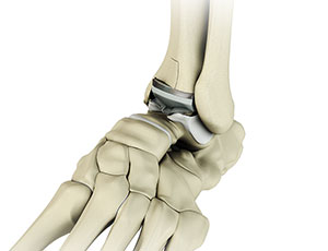 Ankle Joint Replacement - Educational Photo