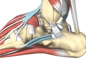 Ankle Ligament Reconstruction - Educational Photo