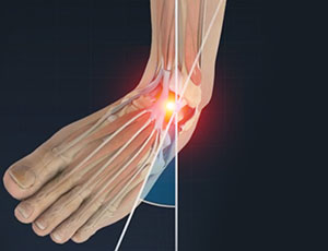 Ankle Sprain - Educational Photo