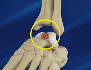 BioCartilage Regeneration - Educational Photo