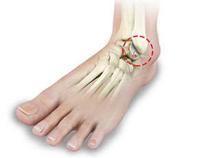 Foot and Ankle Arthritis - Educational Photo