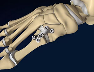 Foot and Ankle Deformity Correction - Educational Photo