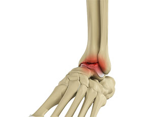 Osteoarthritis - Educational Photo