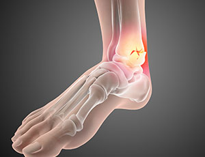 Foot Fracture - Educational Photo