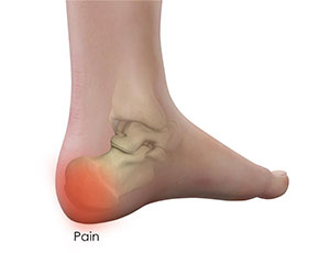 Heel Pain - Educational Photo