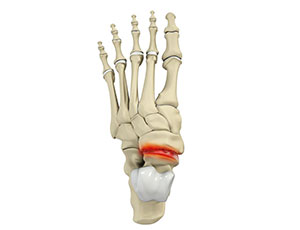 Hindfoot Arthritis - Educational Photo