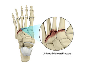 Lisfranc (Midfoot) Injury - Educational Photo