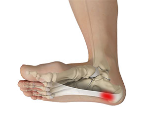 Plantar Fasciitis - Educational Photo