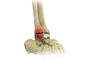 Stress Fractures of Foot and Ankle - Educational Photo