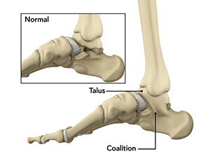 Tarsal Coalition - Educational Photo