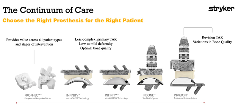 Ankle Joint Replacement - Educational Photo