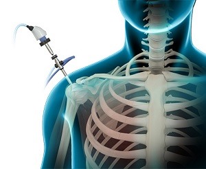 Arthroscopic Surgery pic