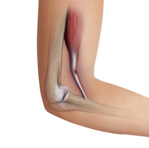 Bicep Tendon Tear at the Elbow pic