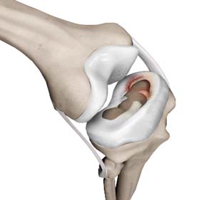 Meniscal Injuries pic