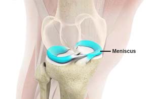 Meniscal Surgery pic
