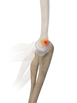 Posterior Impingement of the Elbow pic
