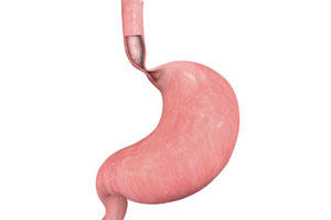 Achalasia - Educational Photo