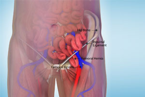 Femoral Hernia - Educational Photo