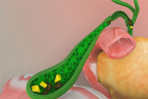 Gallstones - Educational Photo