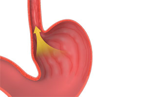 Gastro-oesophageal Reflux Disease Photo