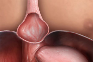 Hiatal Hernia - Educational Photo