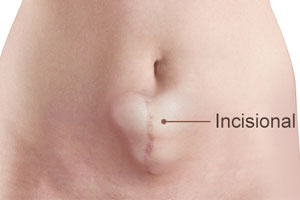 Incisional Hernia - Educational Photo