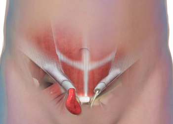 Inguinal Hernia - Educational Photo