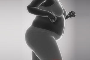 Obesity - Educational Photo