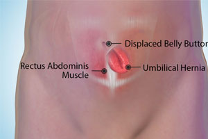 Umbilical Hernia - Educational Photo