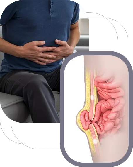 Abdominal & Groin Hernia img