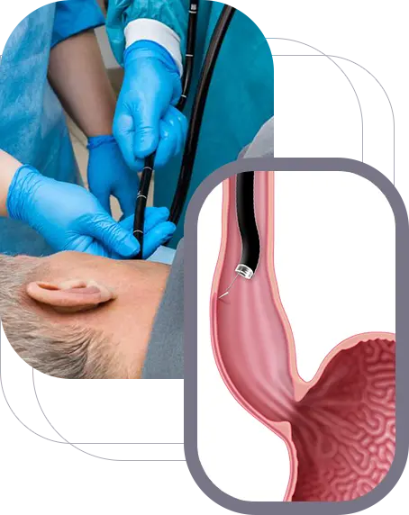 Upper Endoscopy img