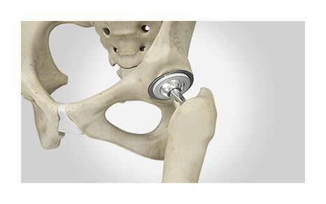 Outpatient Hip Replacement Small Picture