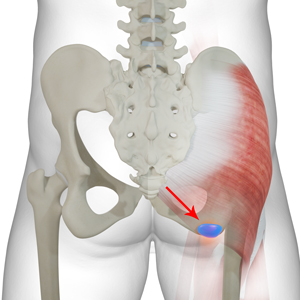 ischial-bursitis-img