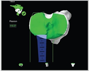 Mako SmartRobotics for Total Knee Replacement