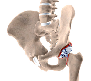 revisional-hip-surgery-img