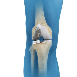 Unicondylar knee Replacement