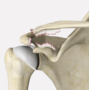 Shoulder_topic_heading - Condition