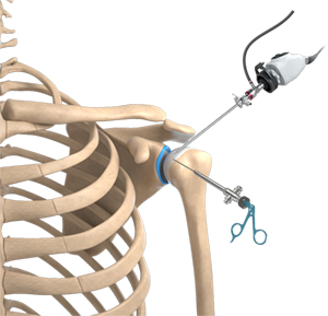 Arthroscopic Surgery