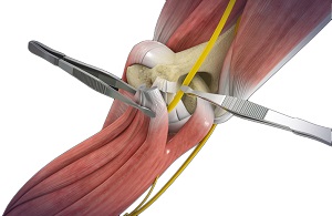 Open Cubital Tunnel Repair